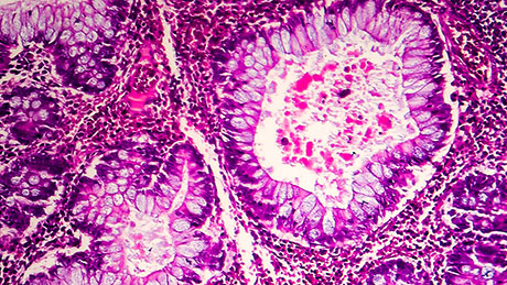 Cancer cells with beneficial mutations spread less quickly in the intestine than in bone marrow, for example, because their habitat is strongly divided by the intestinal villi (round structures). (Symbol image: Adobe Stock)  Cancer cells with beneficial mutations spread less quickly in the intestine than in bone marrow, for example, because their habitat is strongly divided by the intestinal villi (round structures). (Symbol image: Adobe Stock) 