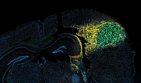 Cerebral tumor (glioma) of a mouse - 2023 EPFL / Michele De Palma - CC-BY-SA 4.0 